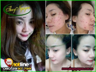 Nguyên Nhân Và Cách Trị Mụn Cám Ở Má Mới Nhất ( Update )